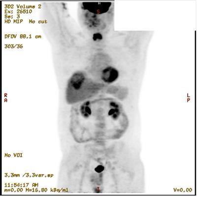 Unveiling the genomic landscape of possible metastatic malignant transformation of teratoma secondary to cisplatin-chemotherapy: a Tempus gene analysis-based case report literature review